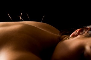 acupuncture back